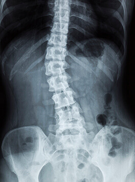 Scoliosis